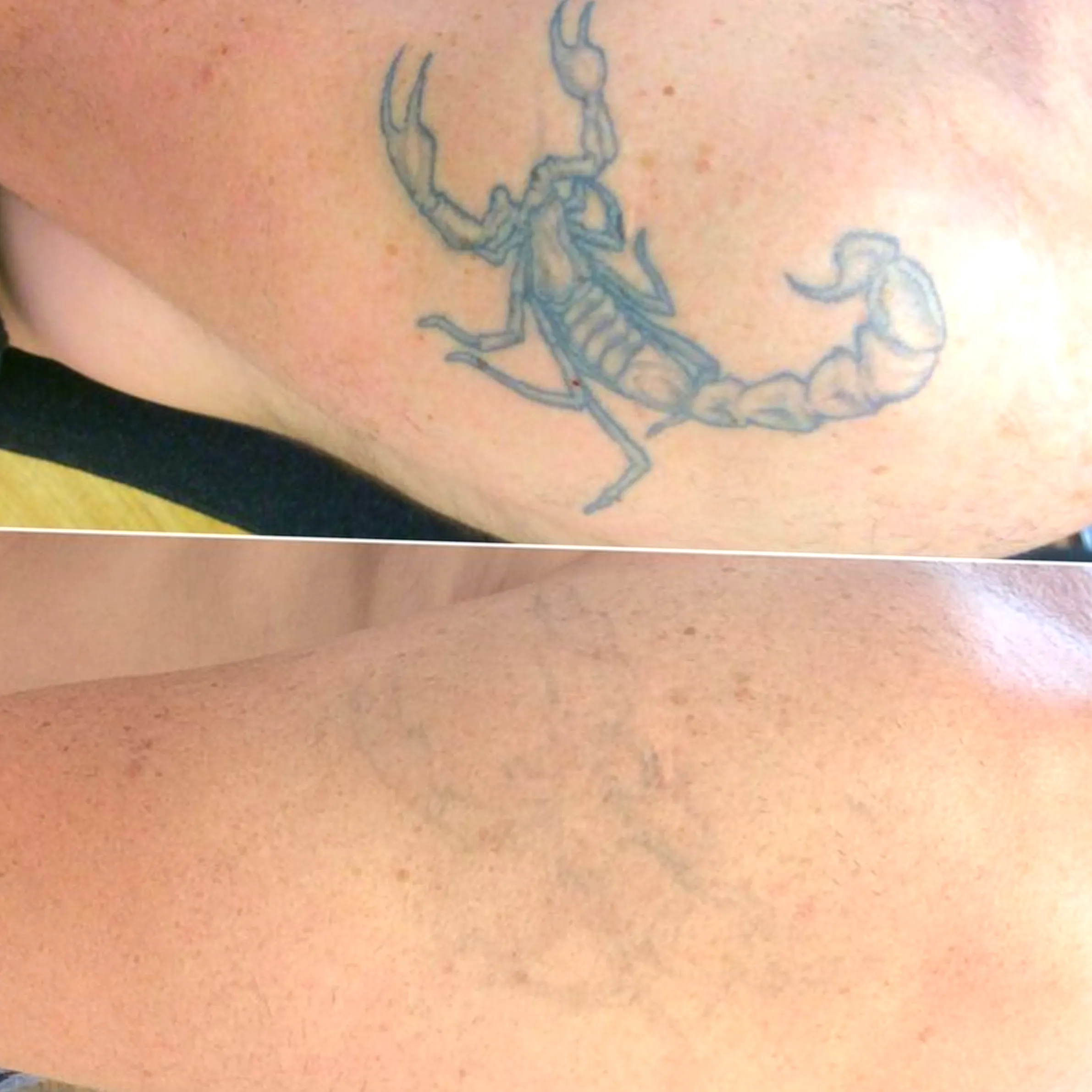 tattoo removal methods