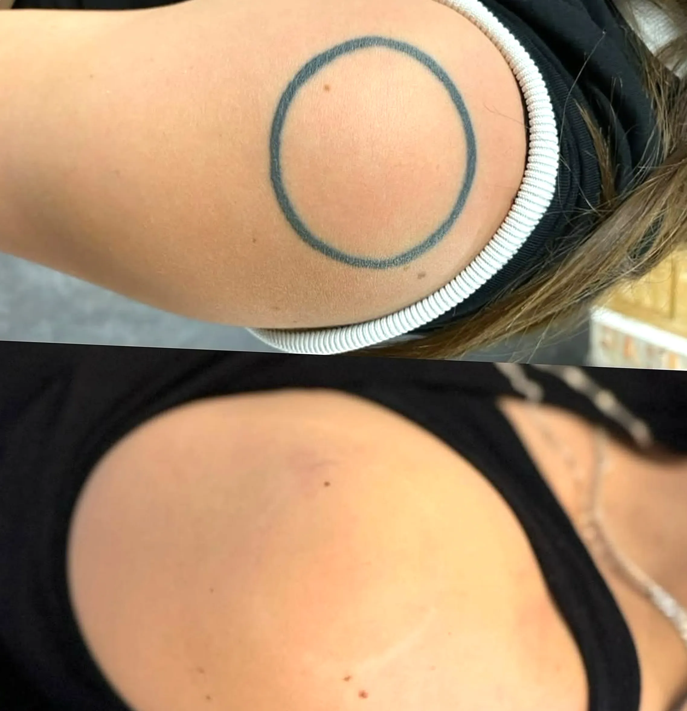 saline tattoo removal