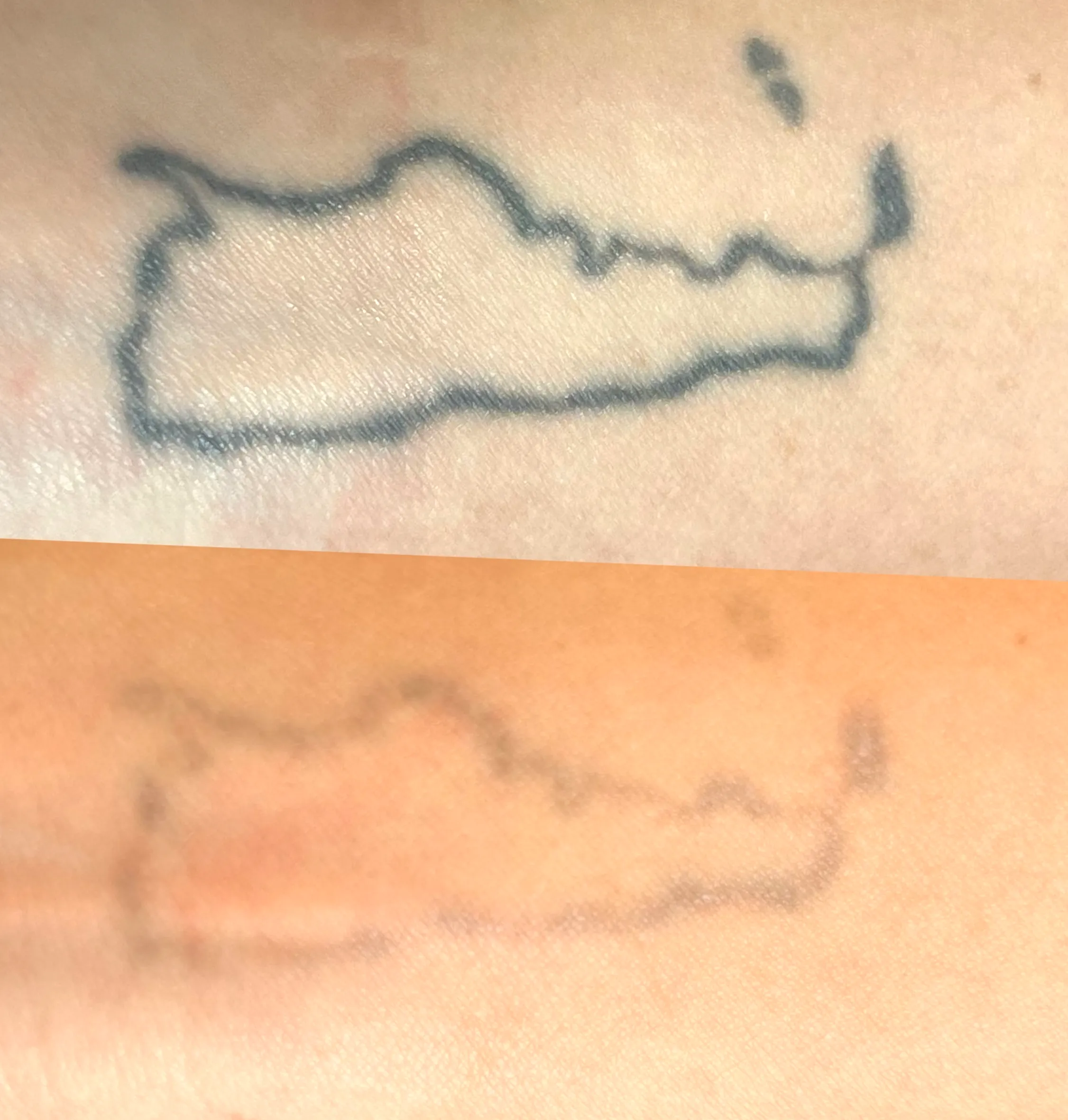 eyebrow tattoo removal