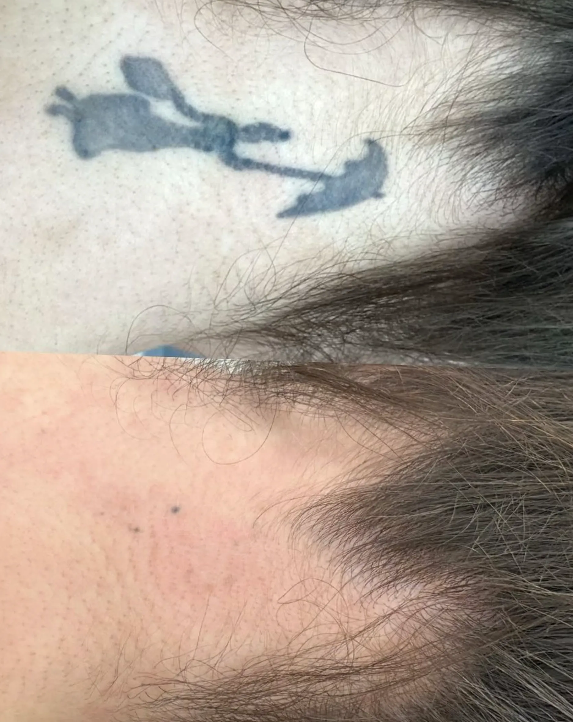 laser tattoo removal