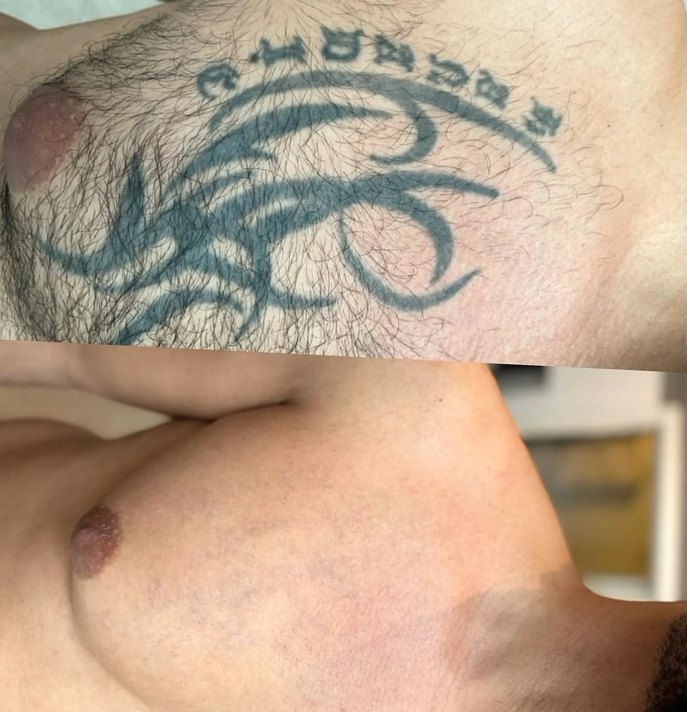 what can remove tattoo ink