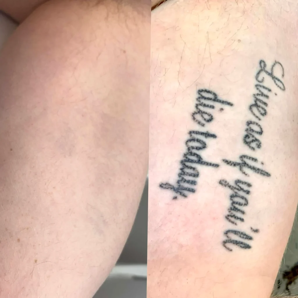 tattoo removal Melbourne